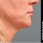 Ultherapy Before & After Patient #1551